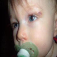 Brayden's Eye healing...
Feb. 22, 2006